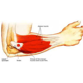 Marchan Medical: Elbow